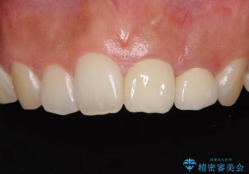 折れてしまって変色した前歯をオールセラミックに