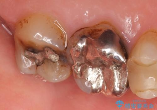 オールセラミッククラウン 欠けた歯の治療の治療前