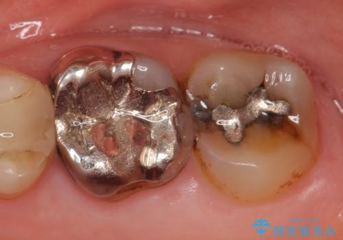 オールセラミッククラウン 欠けた歯の治療の治療前