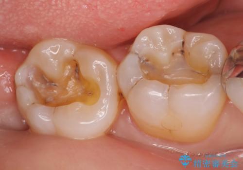 セラミックインレー 古い銀歯をやり直したいの治療中