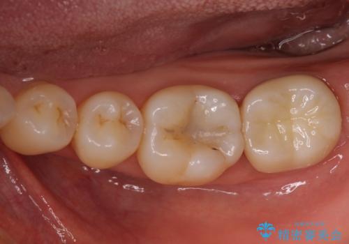 奥歯が割れた 神経が取り除かれた歯のセラミッククラウン治療