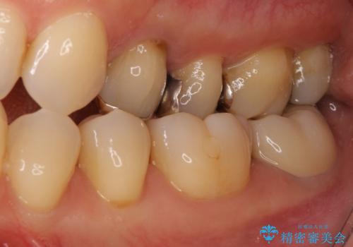 奥歯が割れた 神経が取り除かれた歯のセラミッククラウン治療の治療後