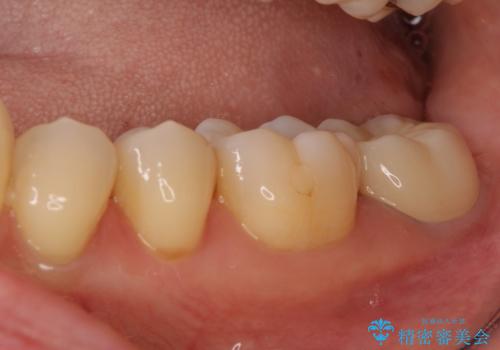 奥歯が割れた 神経が取り除かれた歯のセラミッククラウン治療の治療後