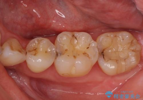 奥歯の虫歯をセラミックインレーにて修復治療の治療前