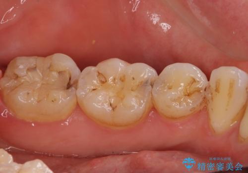 奥歯の虫歯をセラミックインレーにて修復治療の治療前