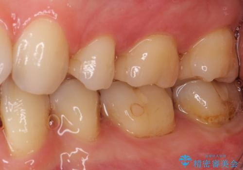 奥歯の虫歯をセラミックインレーにて修復治療の治療前