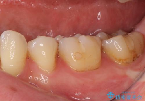 奥歯の虫歯をセラミックインレーにて修復治療の治療前