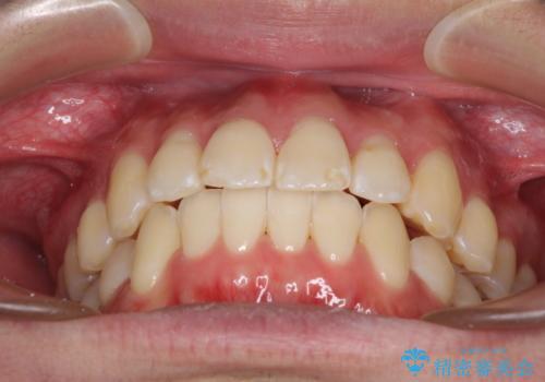 インビザラインで整った口元にの治療後