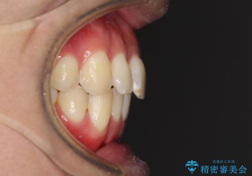 インビザラインで整った口元にの治療後