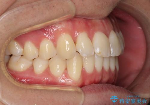 インビザラインで整った口元にの治療後