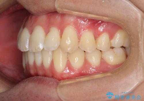 インビザラインで整った口元にの治療後