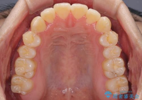 インビザラインで整った口元にの治療後