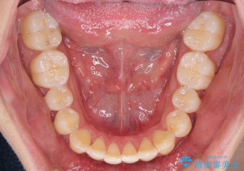 インビザラインで整った口元にの治療後
