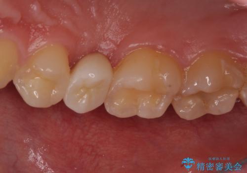 割れた歯を引っ張り出す　右上と左上の虫歯治療の症例 治療後