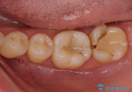 奥歯が割れた 神経が取り除かれた歯のセラミッククラウン治療の治療前