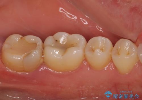 奥歯が割れた 神経が取り除かれた歯のセラミッククラウン治療の治療前