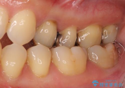 奥歯が割れた 神経が取り除かれた歯のセラミッククラウン治療の治療前