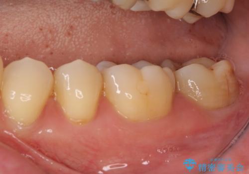 奥歯が割れた 神経が取り除かれた歯のセラミッククラウン治療の治療前