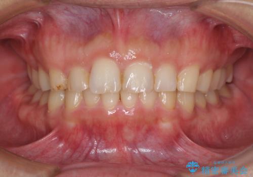 インビザライン矯正とインプラント補綴　深い咬み合わせと奥歯の欠損治療の症例 治療後