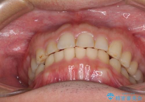 インビザライン矯正とインプラント補綴 深い咬み合わせと奥歯の欠損治療の治療後