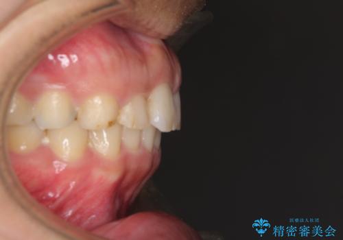 インビザライン矯正とインプラント補綴 深い咬み合わせと奥歯の欠損治療の治療後