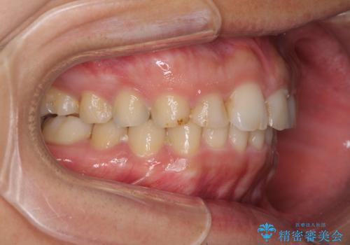 インビザライン矯正とインプラント補綴 深い咬み合わせと奥歯の欠損治療の治療後