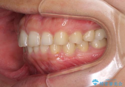 インビザライン矯正とインプラント補綴 深い咬み合わせと奥歯の欠損治療の治療後