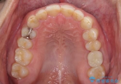 インビザライン矯正とインプラント補綴 深い咬み合わせと奥歯の欠損治療の治療後