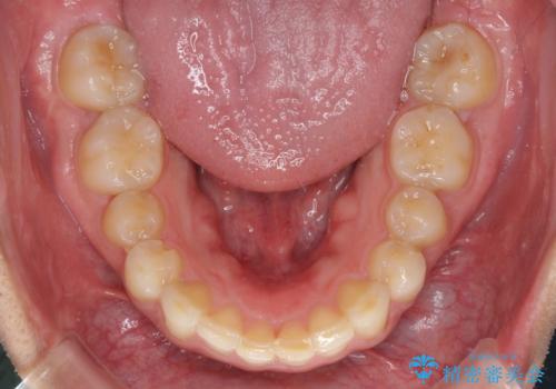 インビザライン矯正とインプラント補綴 深い咬み合わせと奥歯の欠損治療の治療後