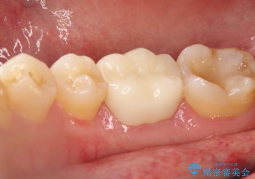 以前治療歯の中が虫歯になっている気がする セラミッククラウンによる再補綴の治療後
