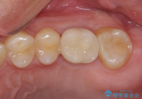 インビザライン矯正とインプラント補綴 深い咬み合わせと奥歯の欠損治療の治療後