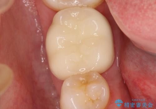 以前治療歯の中が虫歯になっている気がする セラミッククラウンによる再補綴の治療後