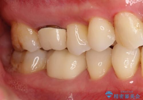 以前治療歯の中が虫歯になっている気がする セラミッククラウンによる再補綴の治療後