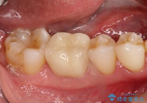 以前治療歯の中が虫歯になっている気がする　セラミッククラウンによる再補綴の治療後