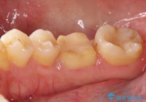 以前治療歯の中が虫歯になっている気がする セラミッククラウンによる再補綴の治療中