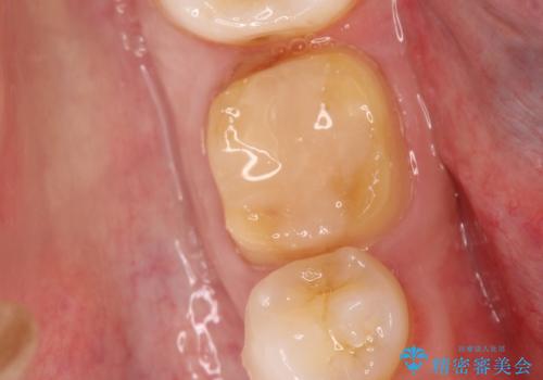 以前治療歯の中が虫歯になっている気がする セラミッククラウンによる再補綴の治療中