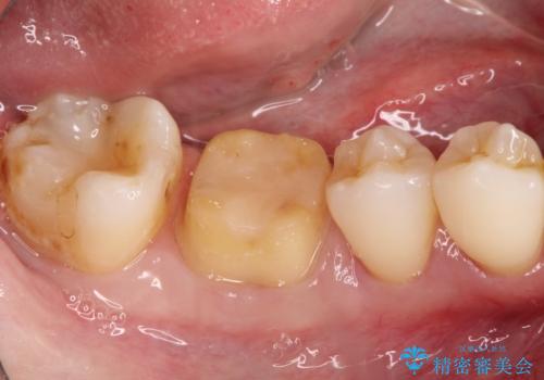 以前治療歯の中が虫歯になっている気がする　セラミッククラウンによる再補綴の治療中