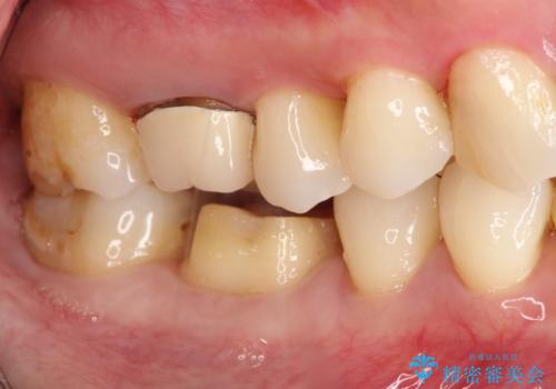 以前治療歯の中が虫歯になっている気がする　セラミッククラウンによる再補綴の治療中