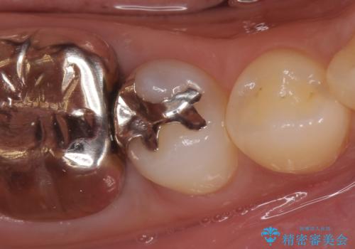 PGA(ゴールド)インレー　深い虫歯の虫歯の治療の症例 治療前