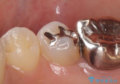 PGA(ゴールド)インレー　深い虫歯の虫歯の治療の治療前
