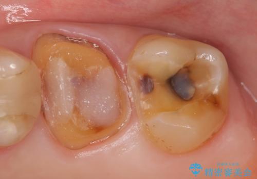 オールセラミッククラウン 欠けた歯の治療の治療中