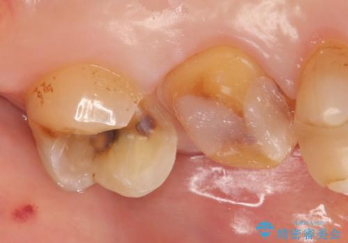 オールセラミッククラウン 欠けた歯の治療の治療中