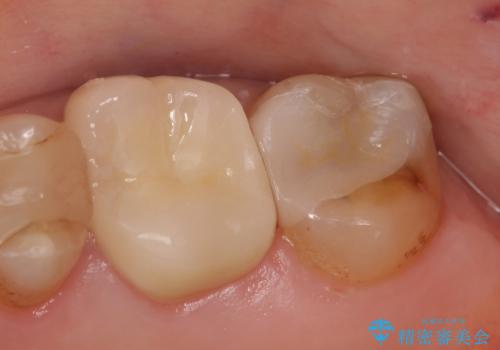 オールセラミッククラウン 欠けた歯の治療の治療後