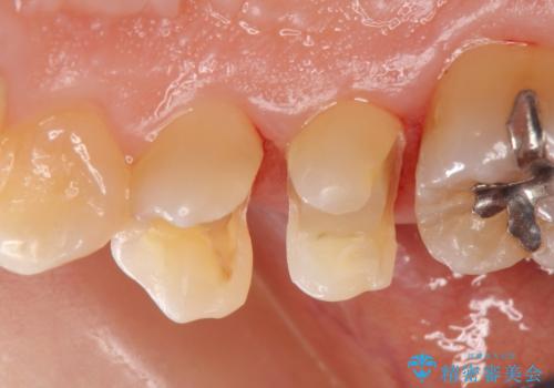 セラミックインレー 古い樹脂の修復の治療中