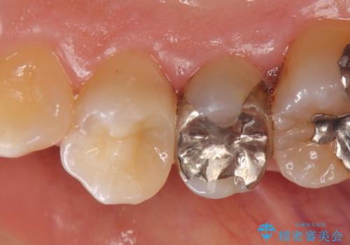 セラミックインレー 古い樹脂の修復の治療後