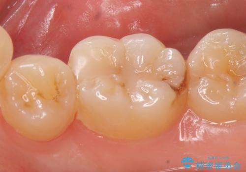 セラミックインレー しみる歯の歯の治療の治療前