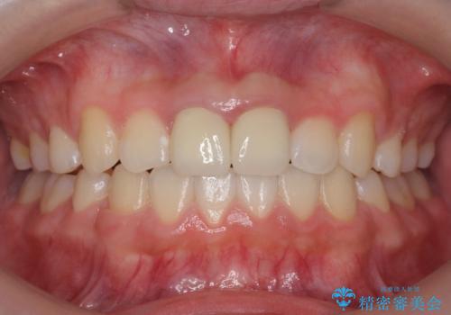 小さいころに前歯を折った　がたがたの矯正+変色した前歯をセラミックにの症例 治療後