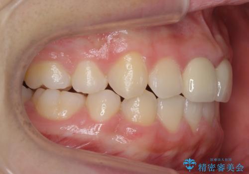 小さいころに前歯を折った　がたがたの矯正+変色した前歯をセラミックにの治療後