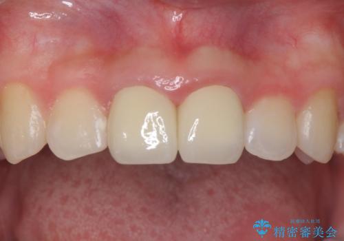 小さいころに前歯を折った がたがたの矯正+変色した前歯をセラミックにの治療後