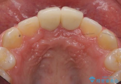 小さいころに前歯を折った がたがたの矯正+変色した前歯をセラミックにの治療後